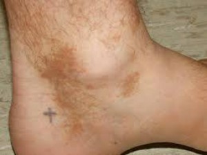 foot diabetic dermopathy pictures)